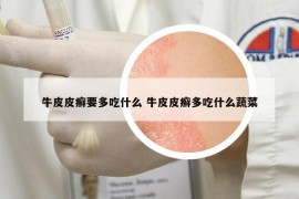 牛皮皮癣要多吃什么 牛皮皮癣多吃什么蔬菜