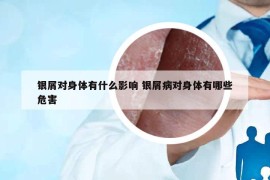 银屑对身体有什么影响 银屑病对身体有哪些危害