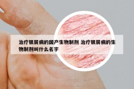 治疗银屑病的国产生物制剂 治疗银屑病的生物制剂叫什么名字