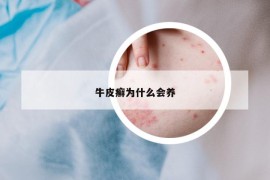 牛皮癣为什么会养