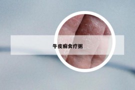 牛皮癣食疗粥