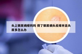 头上银屑病痒妈妈 得了银屑病头皮痒并且头屑多怎么办