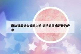 斑块银屑病会长脸上吗 斑块银屑病好转的迹象