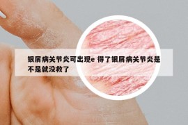银屑病关节炎可出现e 得了银屑病关节炎是不是就没救了