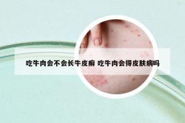 吃牛肉会不会长牛皮癣 吃牛肉会得皮肤病吗