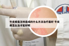 牛皮癣是怎样造成的什么方法治疗最好 牛皮癣怎么治才能好呢