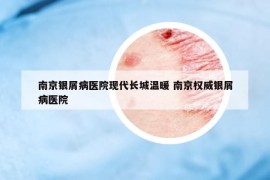 南京银屑病医院现代长城温暖 南京权威银屑病医院