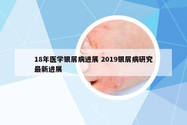 18年医学银屑病进展 2019银屑病研究最新进展