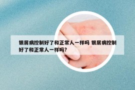 银屑病控制好了和正常人一样吗 银屑病控制好了和正常人一样吗?