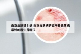 南京皮肤银痟病 南京皮肤病研究所看银屑病最好的医生是哪位