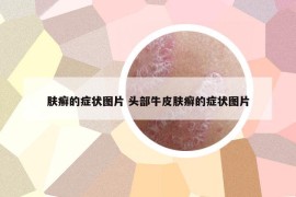 肤癣的症状图片 头部牛皮肤癣的症状图片