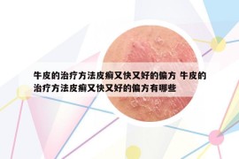 牛皮的治疗方法皮癣又快又好的偏方 牛皮的治疗方法皮癣又快又好的偏方有哪些