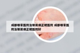 成都哪家医院治银屑病正规医院 成都哪家医院治银屑病正规医院好