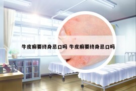牛皮癣要终身忌口吗 牛皮癣要终身忌口吗