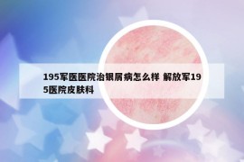 195军医医院治银屑病怎么样 解放军195医院皮肤科
