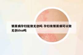 银屑病孕妇能做无创吗 孕妇有银屑病可以做无创dna吗
