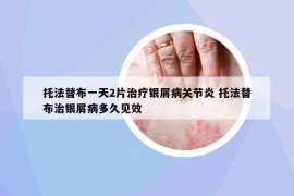托法替布一天2片治疗银屑病关节炎 托法替布治银屑病多久见效