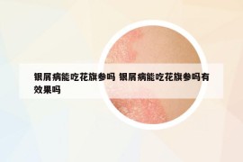 银屑病能吃花旗参吗 银屑病能吃花旗参吗有效果吗