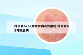 维生表b2b6对银屑病有郊果吗 维生素b2与银屑病