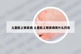 儿童脸上银屑病 儿童脸上银屑病用什么药膏