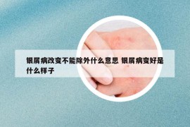 银屑病改变不能除外什么意思 银屑病变好是什么样子
