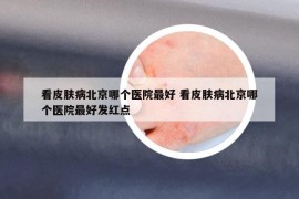 看皮肤病北京哪个医院最好 看皮肤病北京哪个医院最好发红点