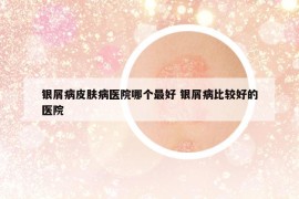 银屑病皮肤病医院哪个最好 银屑病比较好的医院