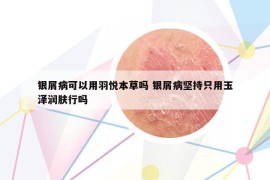 银屑病可以用羽悦本草吗 银屑病坚持只用玉泽润肤行吗