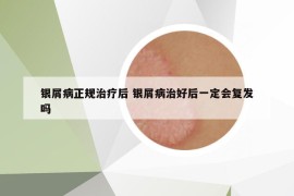 银屑病正规治疗后 银屑病治好后一定会复发吗