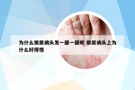 为什么银屑病头发一撮一撮呢 银屑病头上为什么好得慢