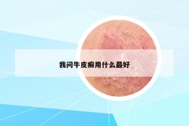 我问牛皮癣用什么最好