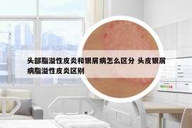 头部脂溢性皮炎和银屑病怎么区分 头皮银屑病脂溢性皮炎区别