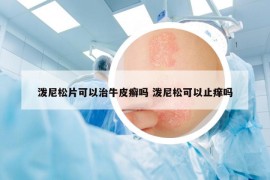 泼尼松片可以治牛皮癣吗 泼尼松可以止痒吗