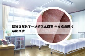 后背突然长了一块癣怎么回事 牛皮皮癣图片早期症状