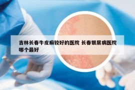 吉林长春牛皮癣较好的医院 长春银屑病医院哪个最好