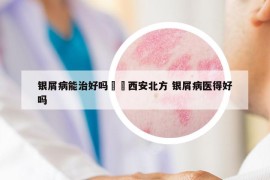 银屑病能治好吗問詢西安北方 银屑病医得好吗