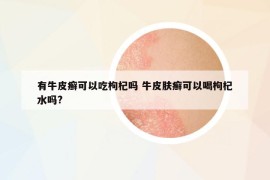 有牛皮癣可以吃枸杞吗 牛皮肤癣可以喝枸杞水吗?