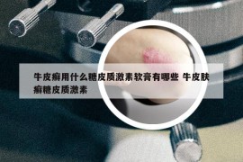 牛皮癣用什么糖皮质激素软膏有哪些 牛皮肤癣糖皮质激素