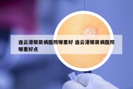 连云港银屑病医院哪里好 连云港银屑病医院哪里好点