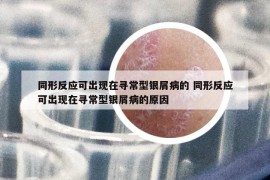 同形反应可出现在寻常型银屑病的 同形反应可出现在寻常型银屑病的原因