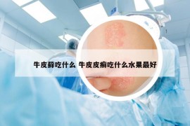 牛皮藓吃什么 牛皮皮癣吃什么水果最好