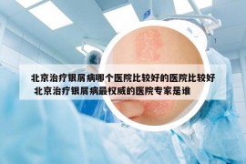 北京治疗银屑病哪个医院比较好的医院比较好 北京治疗银屑病最权威的医院专家是谁