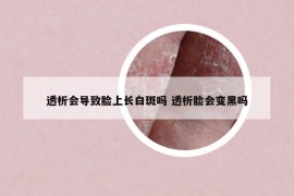 透析会导致脸上长白斑吗 透析脸会变黑吗