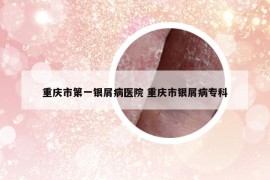 重庆市第一银屑病医院 重庆市银屑病专科