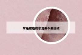 掌跖脓疱病水泡要不要挑破