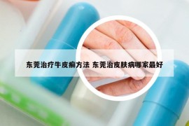 东莞治疗牛皮癣方法 东莞治皮肤病哪家最好