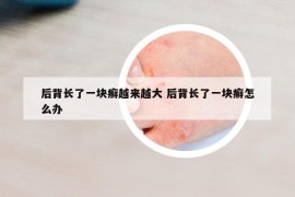 后背长了一块癣越来越大 后背长了一块癣怎么办