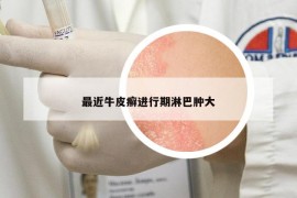 最近牛皮癣进行期淋巴肿大