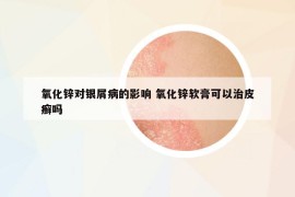 氧化锌对银屑病的影响 氧化锌软膏可以治皮癣吗