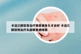 卡泊三醇软膏治疗银屑病多久才会好 卡泊三醇搽剂治疗头部银屑病观察